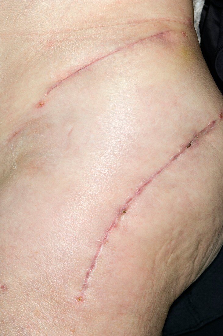 Scars from total hip replacement