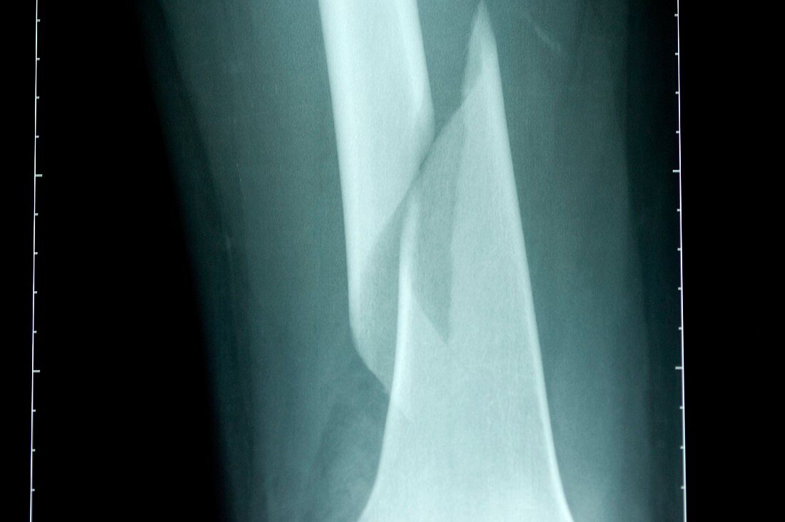 Broken femur bone of the leg,X-ray
