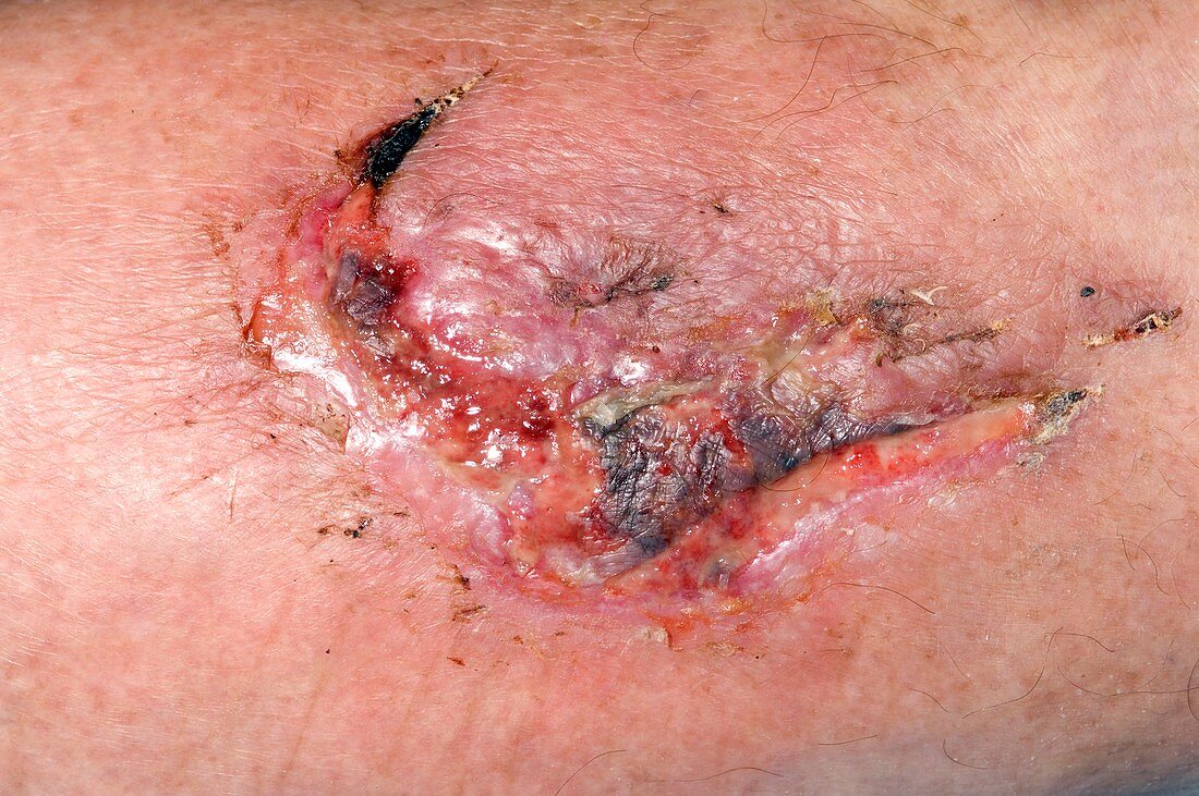 Skin wound healing after car accident