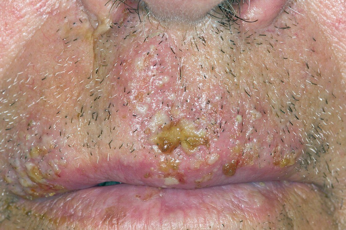 Cold sores around the mouth