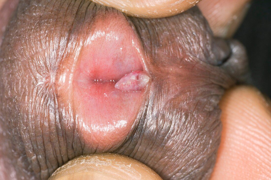 Warts on the penis