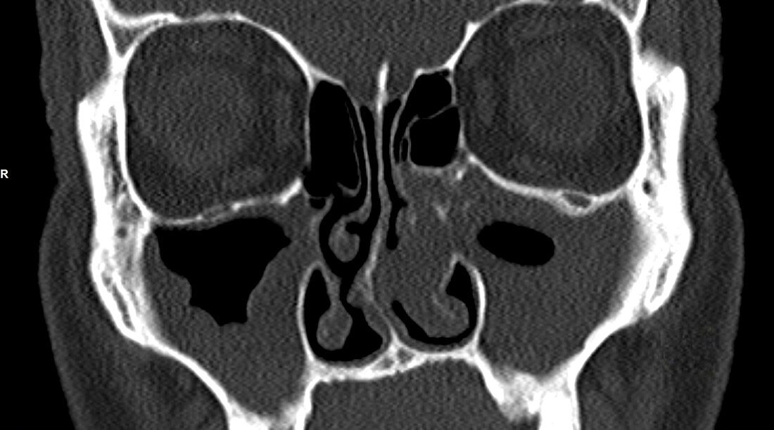 Nasal polyp,coronal CT scan