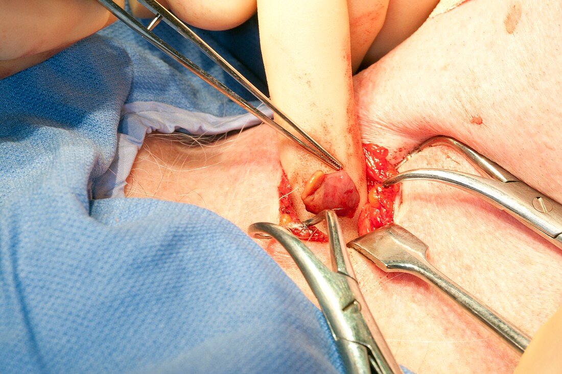 Parathyroid tumour surgery