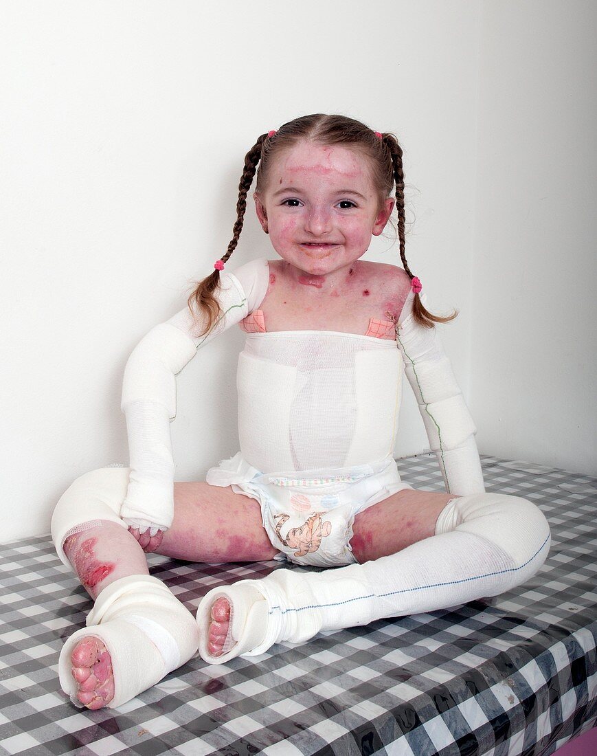 Young girl with epidermylosis bullosa