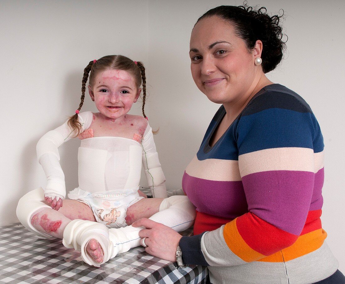 Girl with epidermylosis bullosa & mother