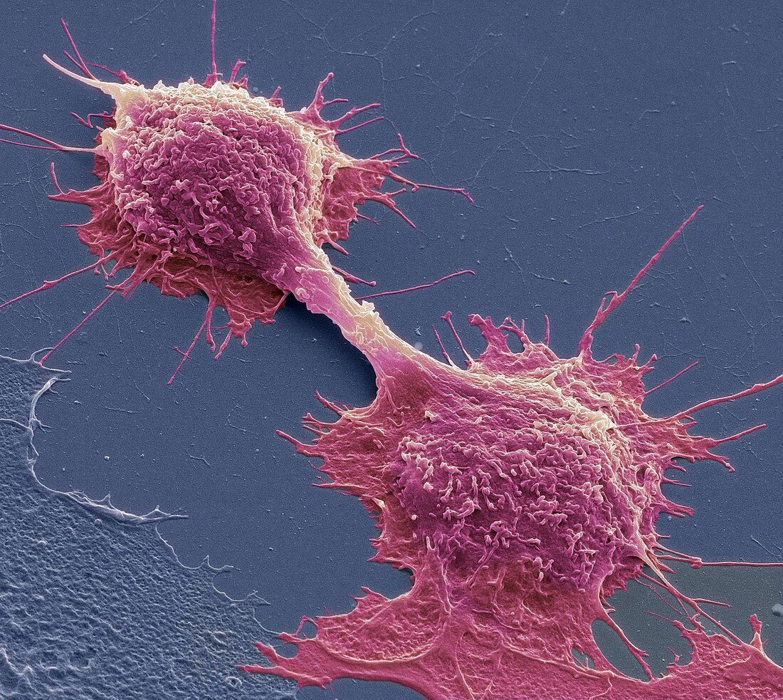 Dividing cancer cells,SEM