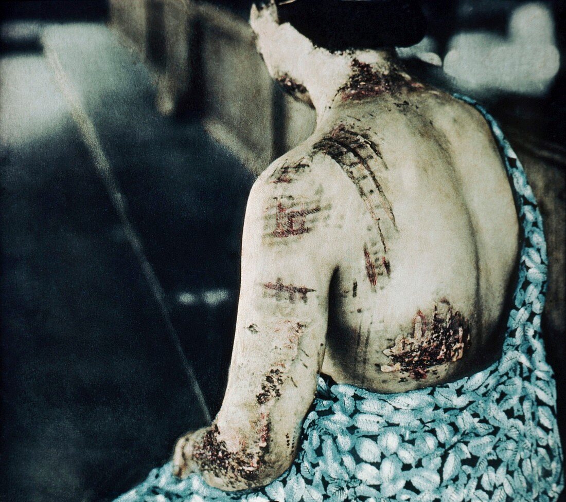 Radiation burns,Hiroshima,1945