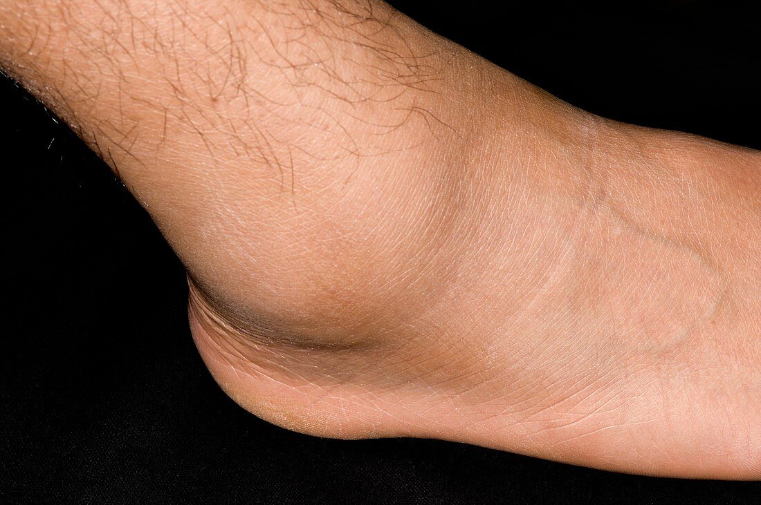 Sprained ankle sport's injury