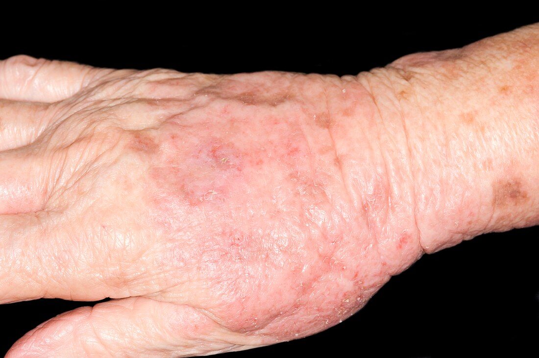Spongiotic dermatitis on the hand