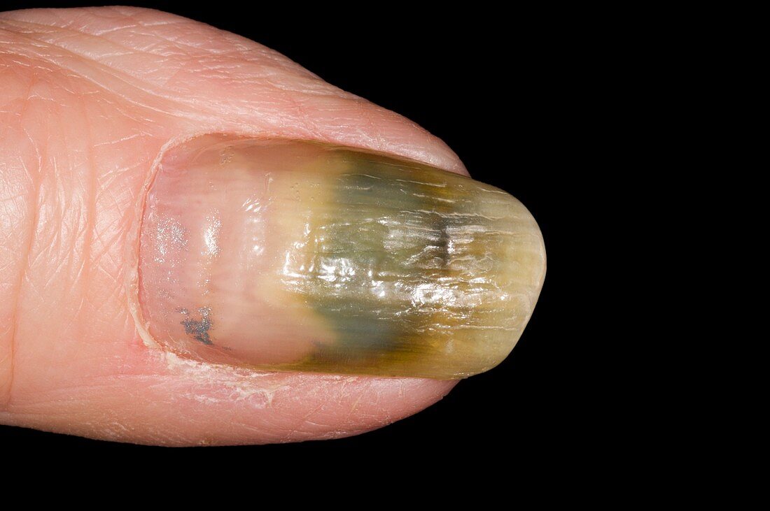 Fungal nail infection of the thumb