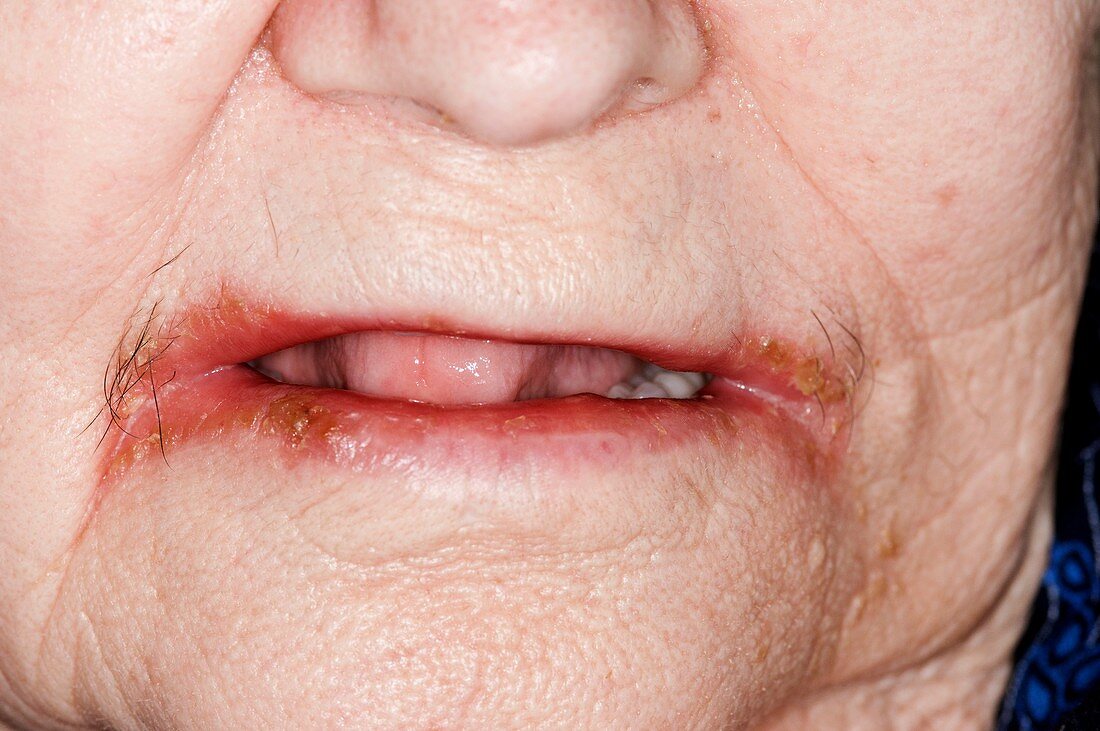 Angular stomatitis of the lips