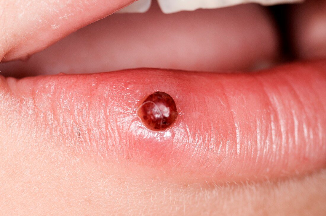 Pyogenic granuloma on the lip