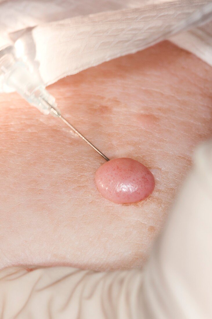 Excision biopsy of a skin tumour