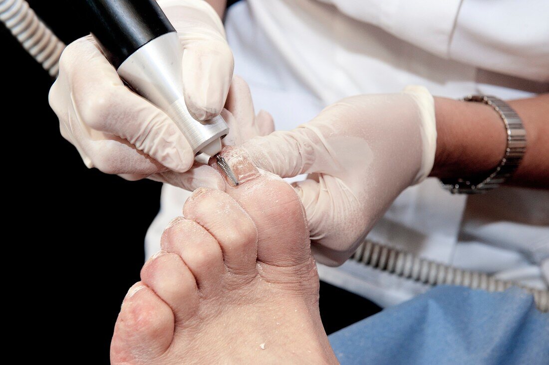 Podiatry treatment of the foot