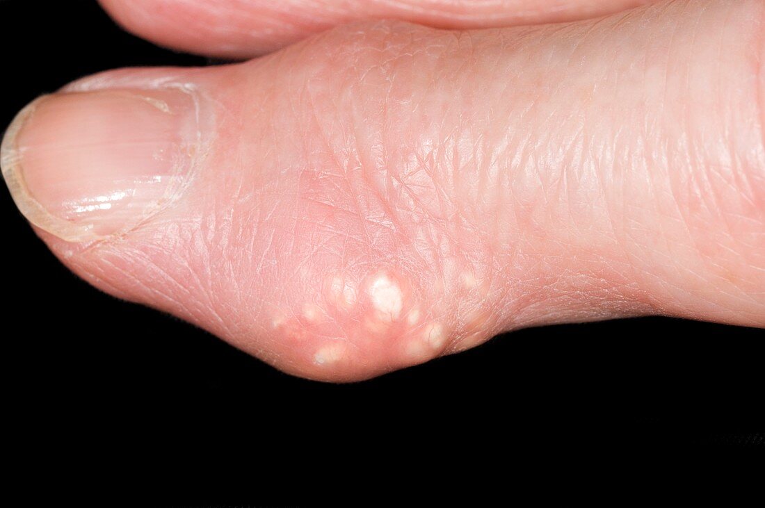 Gout tophus on the finger