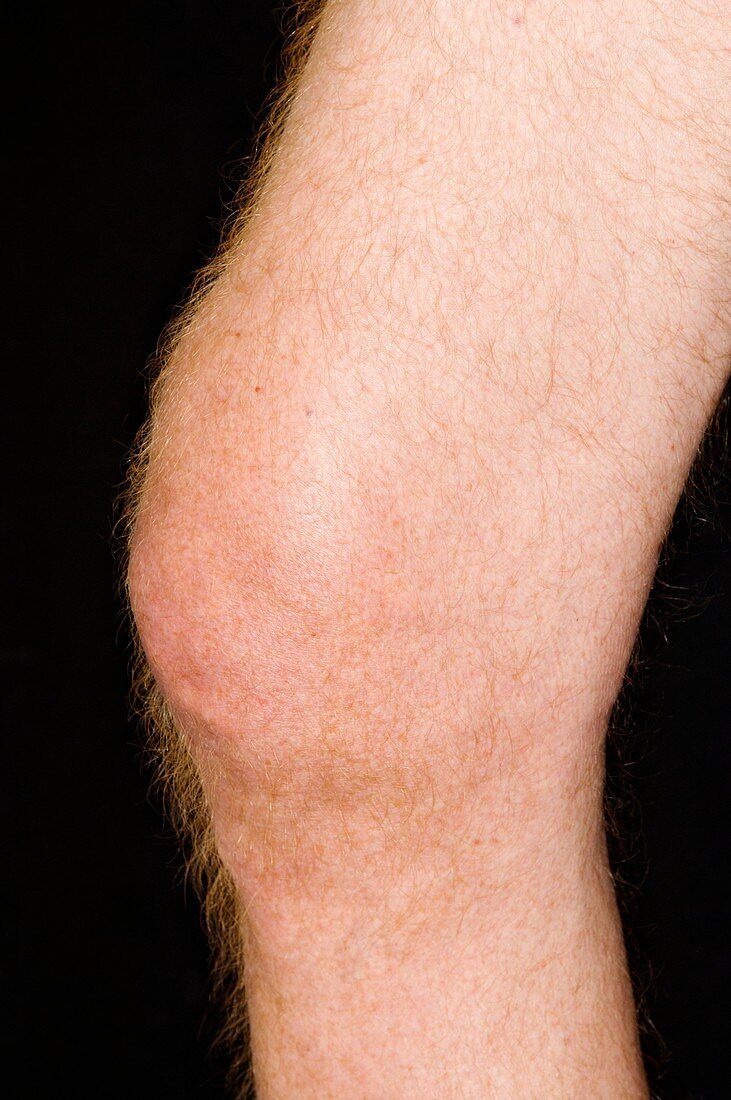 Gout in the knee