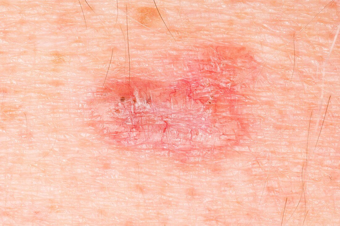 Basal cell skin cancer on the abdomen