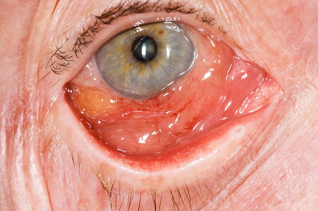 Conjunctival oedema in the eye