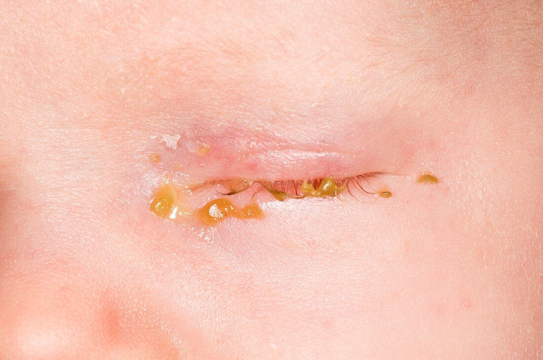 Sticky eyes in a newborn baby