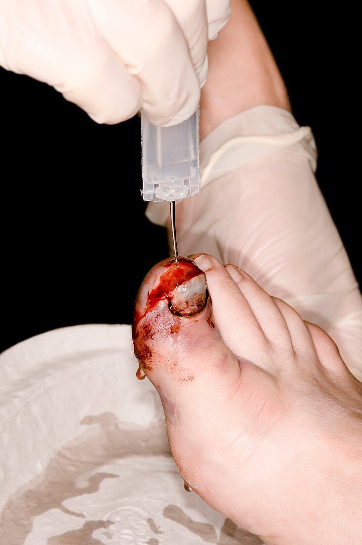 Treating a crushed broken toe