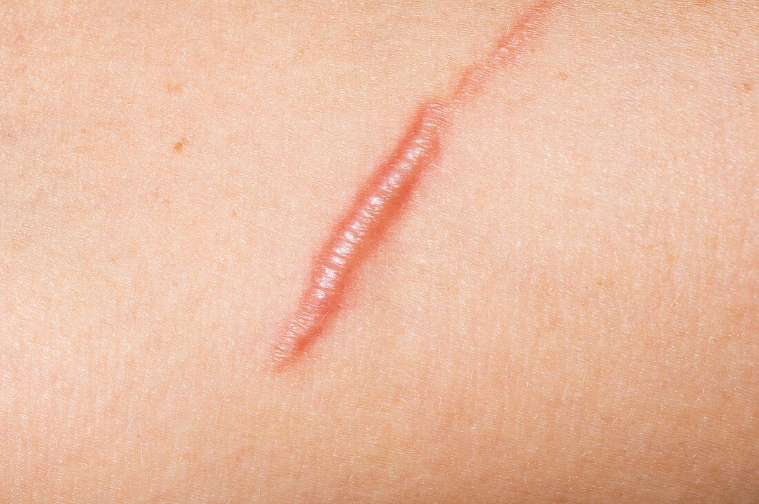 Keloid scar from a cat scratch