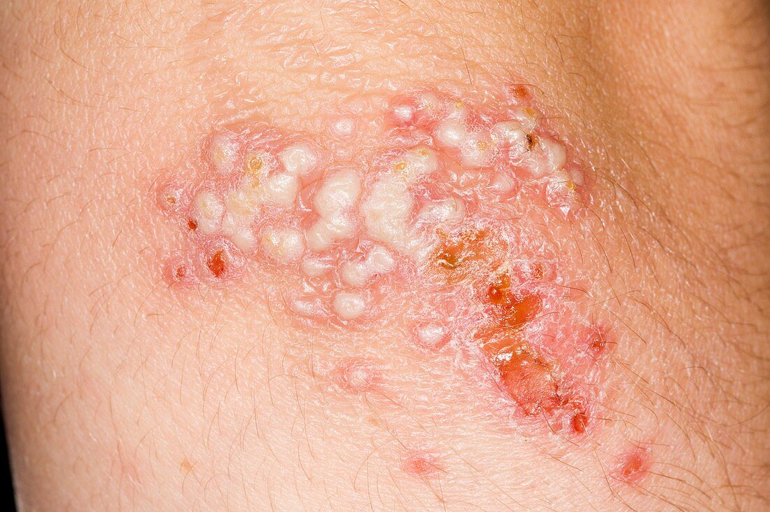 Herpes simplex lesions on the elbow