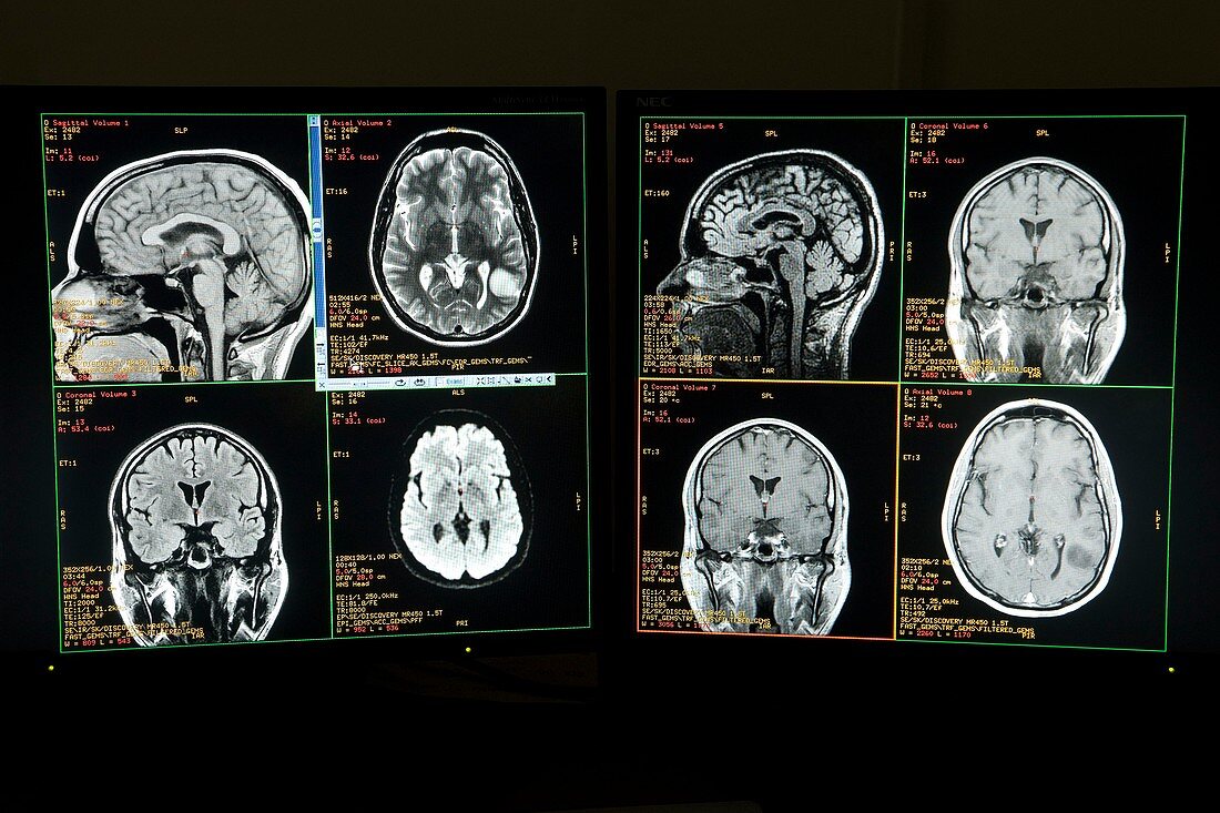 Brain CT scanning