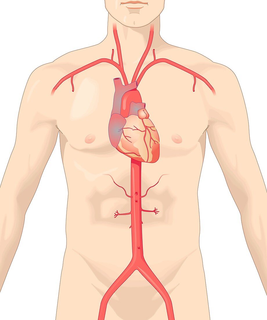 Aortic artery and aneurysm,artwork