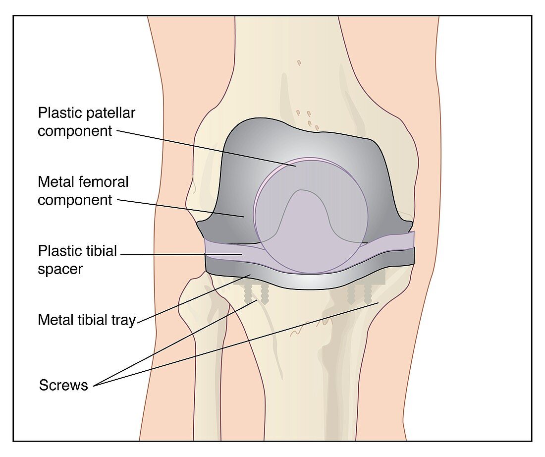 Knee after knee replacement,artwork