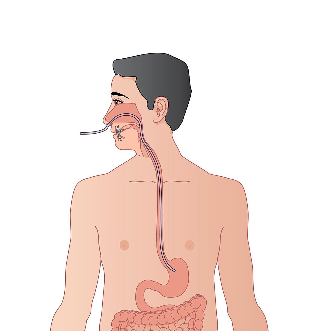 Nasogastric tube,artwork