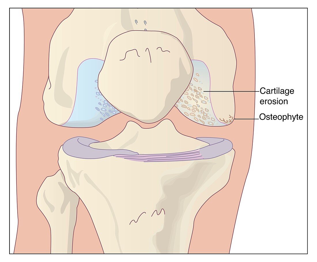 Osteoarthritic knee,artwork