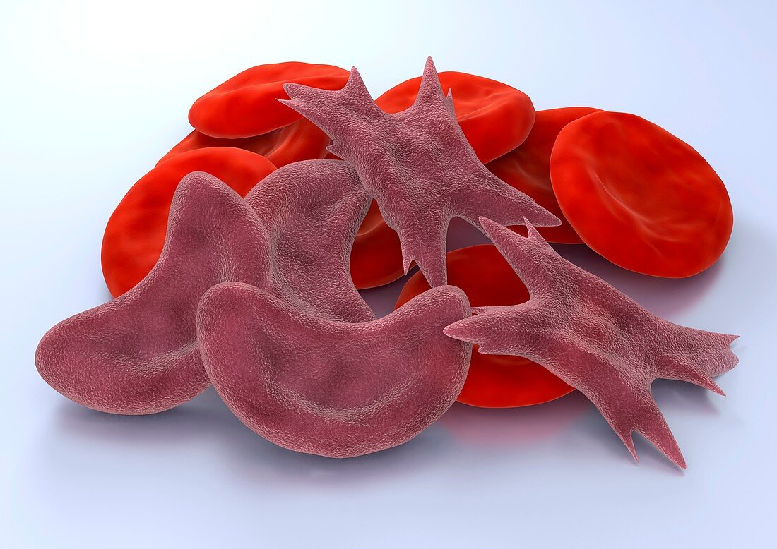 Sickle cell anaemia,artwork