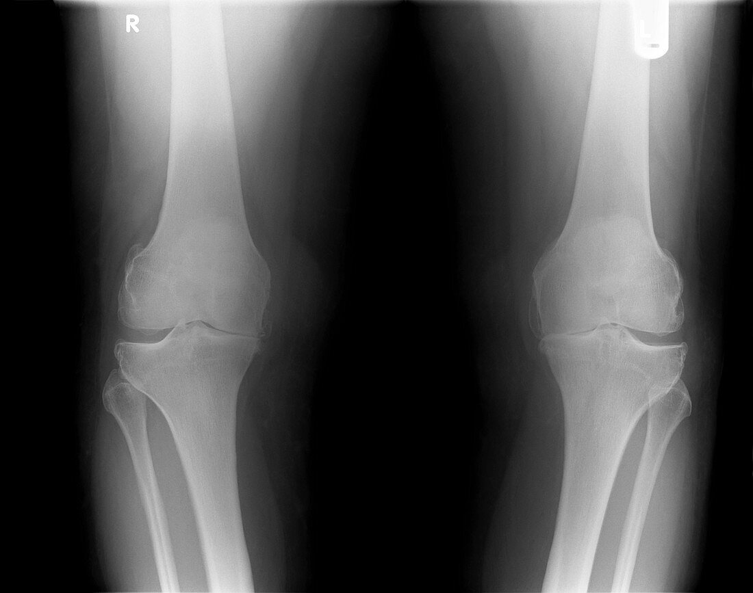 Osteoarthritis of the knees,X-ray