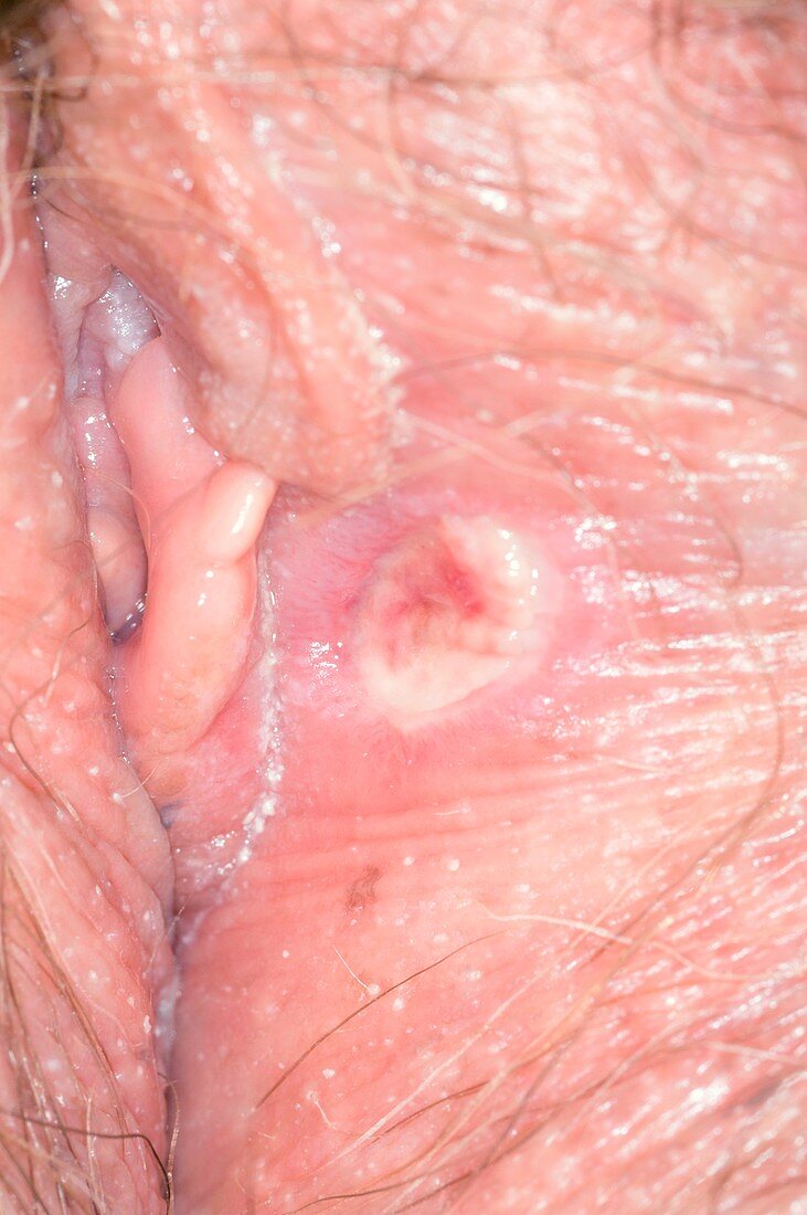 Inflamed vulva after biopsy