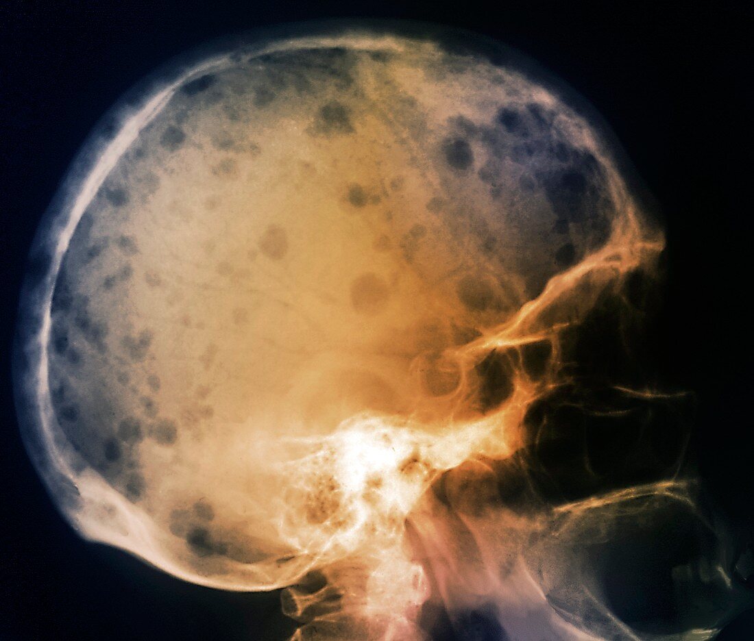 Skull in bone marrow cancer,X-ray