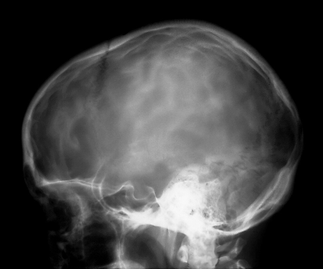 Hypertension inside the skull,X-ray