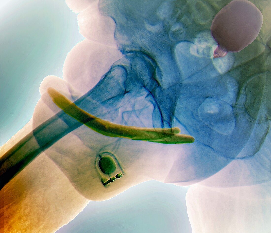 Penis prosthesis with pump,X-ray