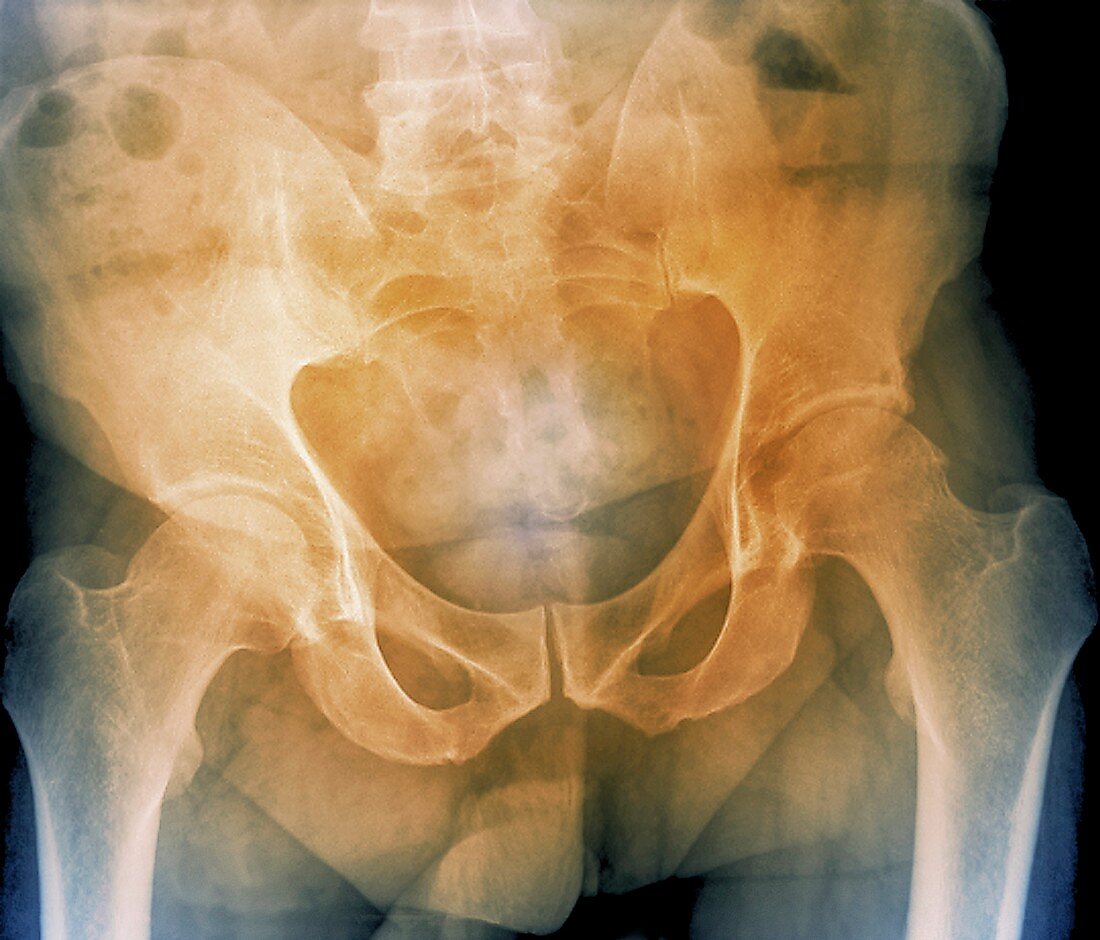 Pelvis with a leaning posture,X-ray