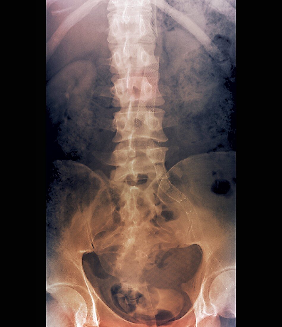 Stents to treat aortic aneurysms,X-ray