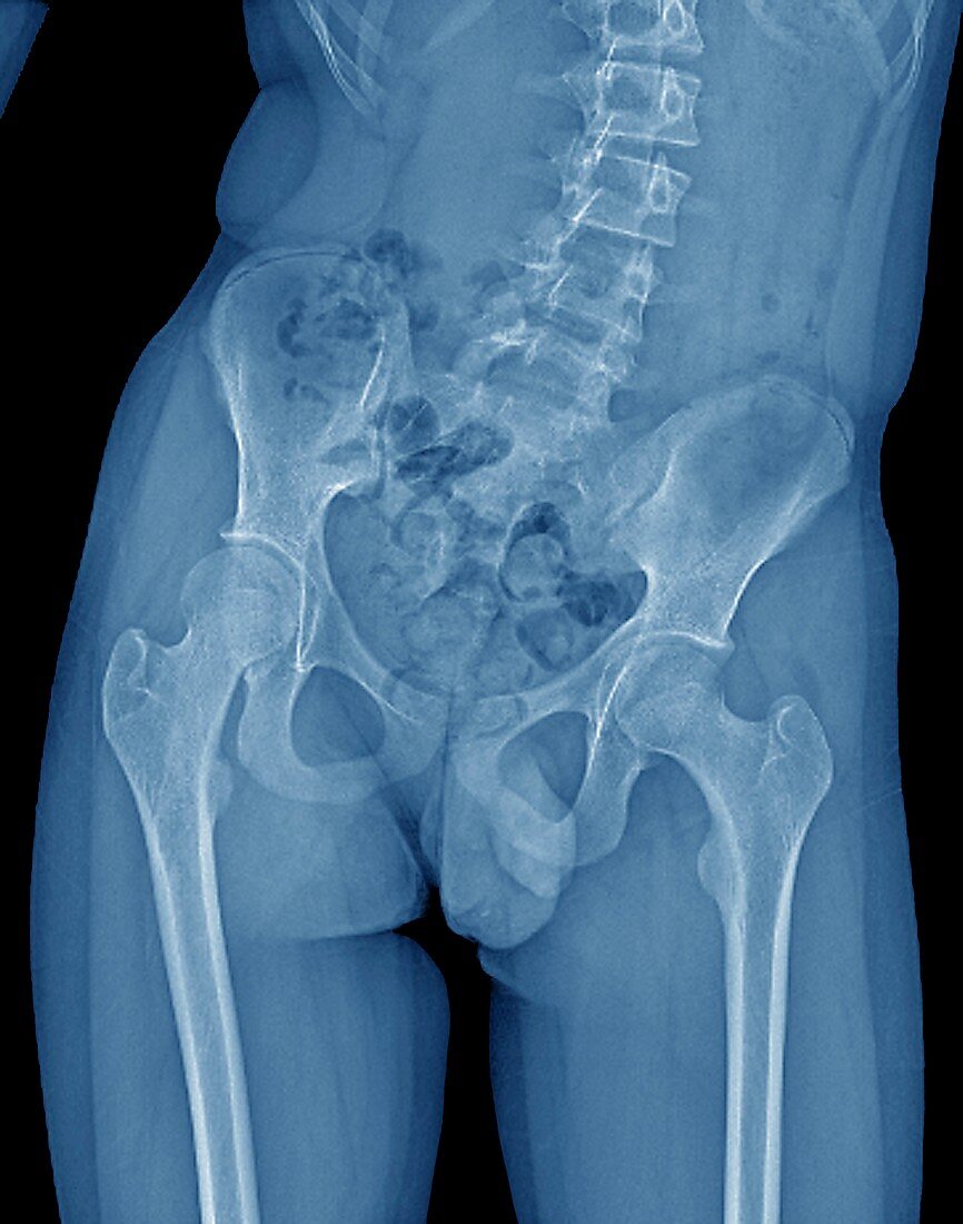 Scoliosis of the spine,X-ray