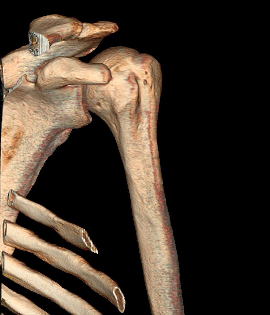 Healthy shoulder bones,3D CT scan