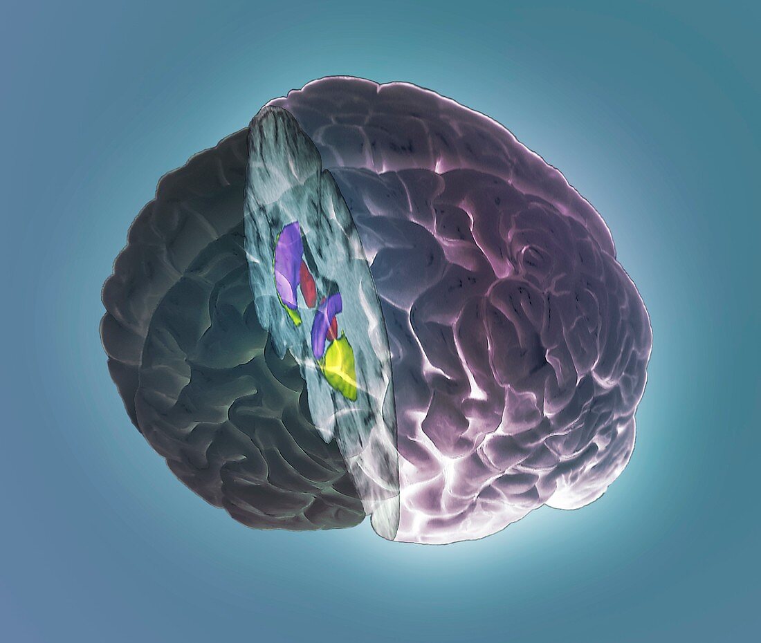 Brain limbic system,3D MRI scan