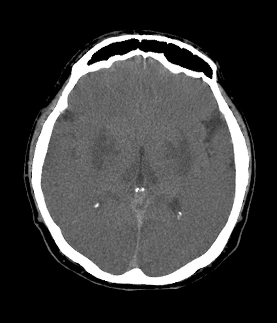 Brain in a coma,CT scan