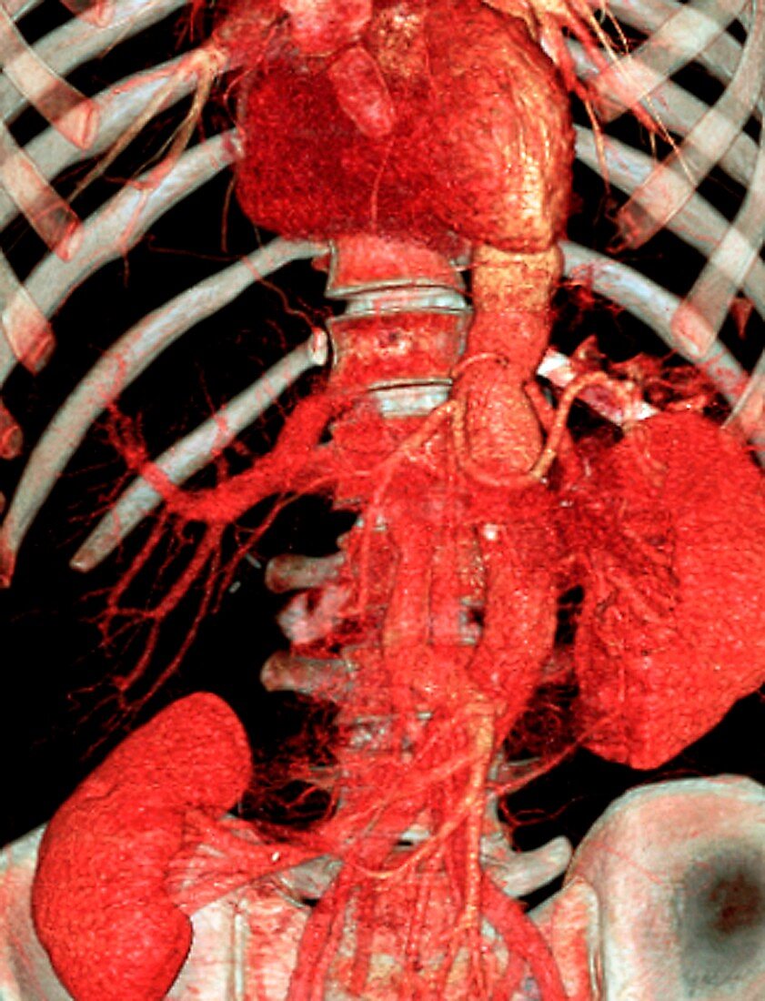 Aortic artery prosthesis,3D CT scan
