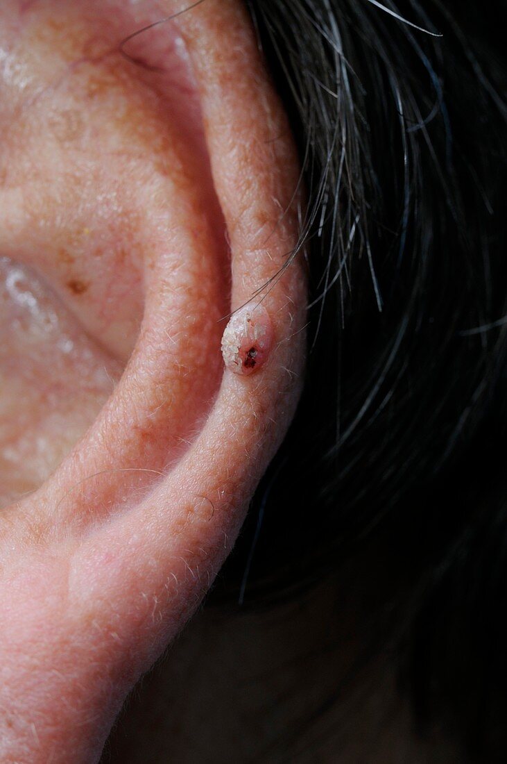Chondrodermatitis lesion on the ear