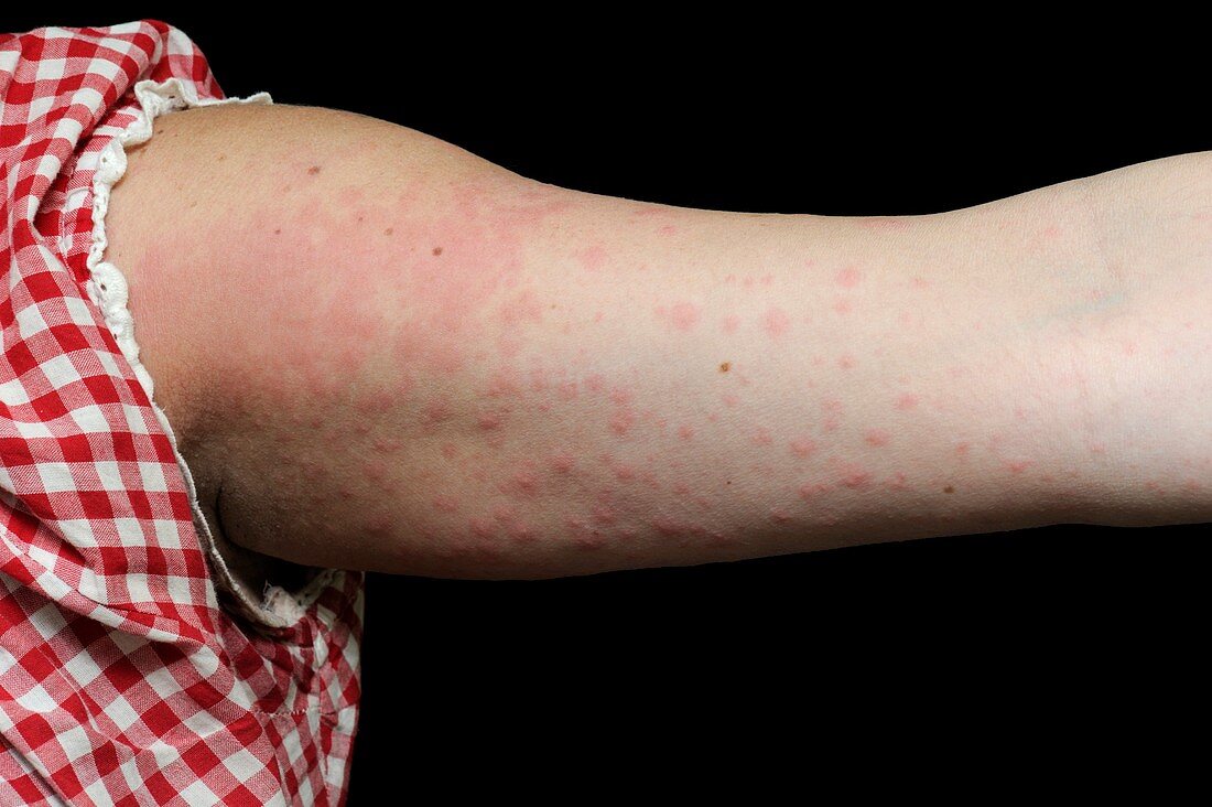 Allergic skin reaction to a drug