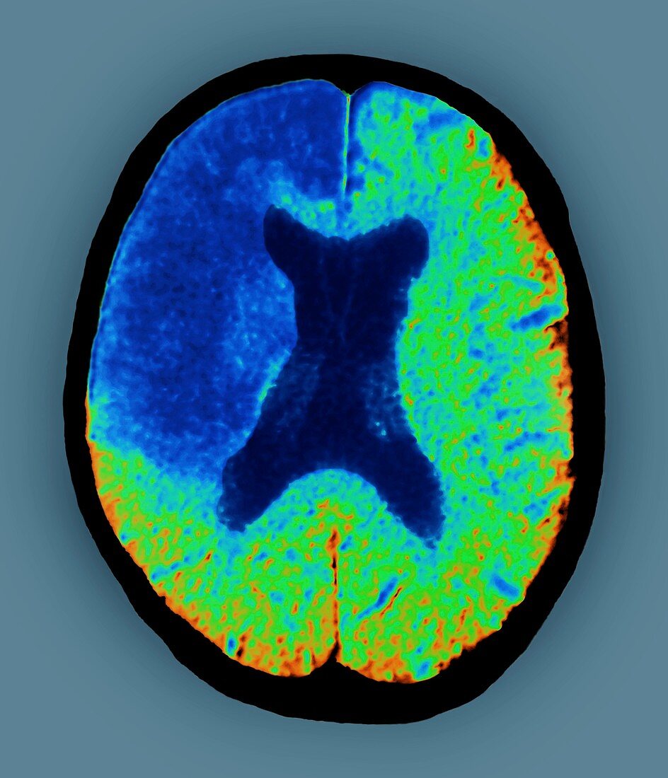 Cerebral stroke,CT scan