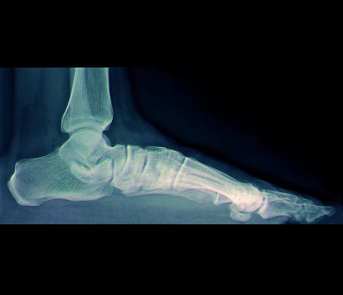Flat foot,X-ray