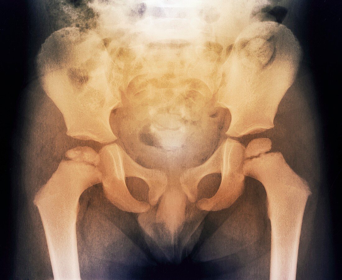 Growth disorder of thigh bone,X-ray