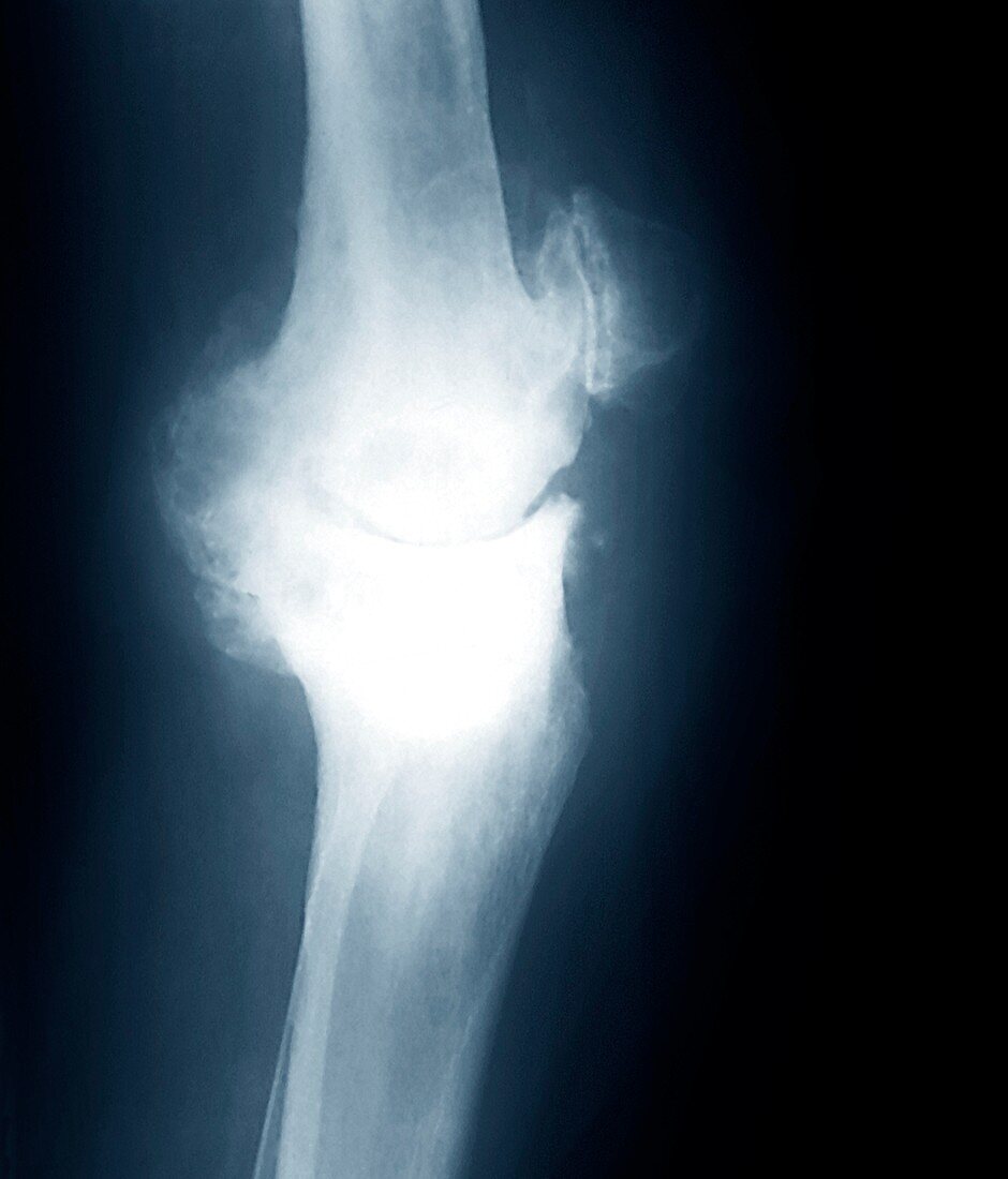 Osteoarthritis of the knee,X-ray